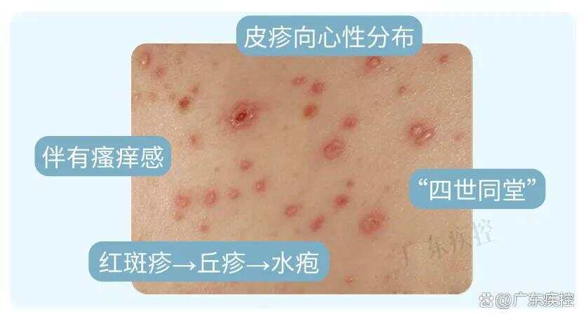 1岁男孩被邻居女子亲吻后发烧确诊水痘，男孩母亲：她的孩子发水痘刚出院